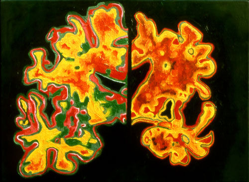 alzheimers